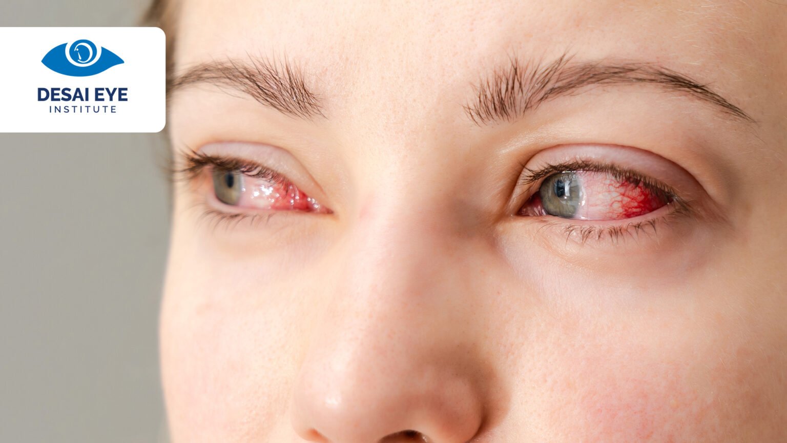 Splinter Eye Infection How to Cure an Eye Infection in 24 Hours: Tips and Treatments - Desai ...